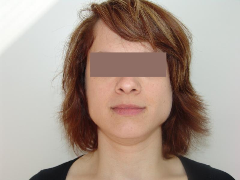 fig_1_bruxisme_.JPG.jpg